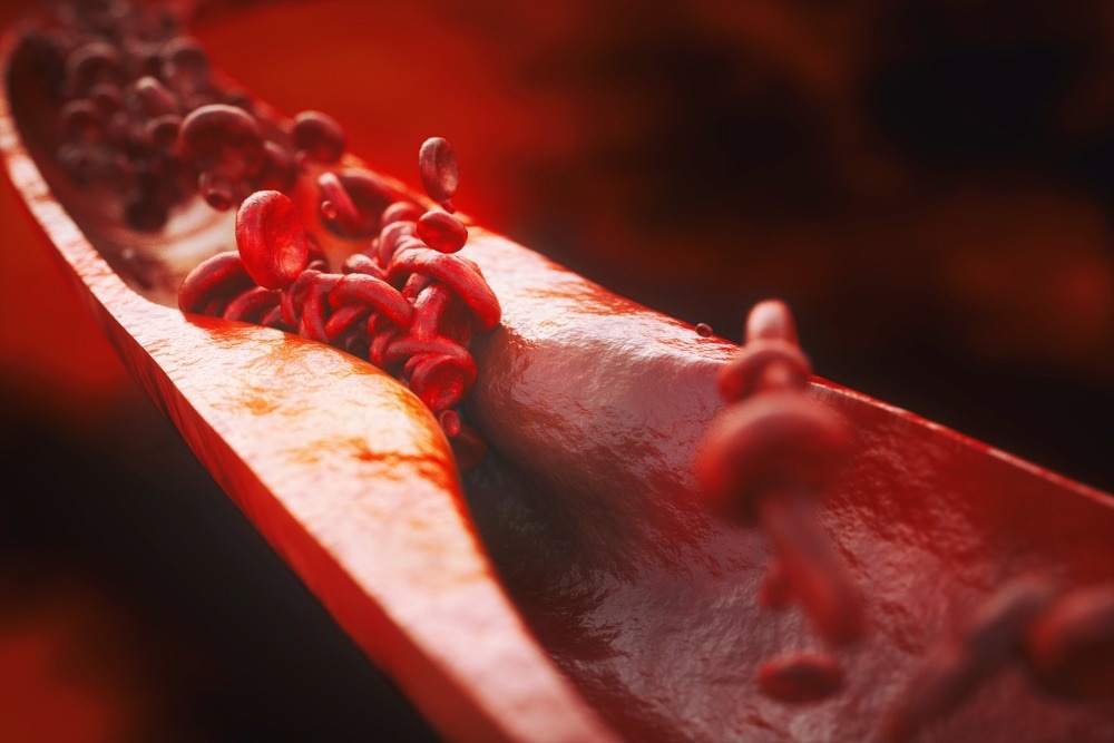 Study: SARS-CoV-2 infection triggers pro-atherogenic inflammatory responses in human coronary vessels. Image Credit: Crevis/Shutterstock.com