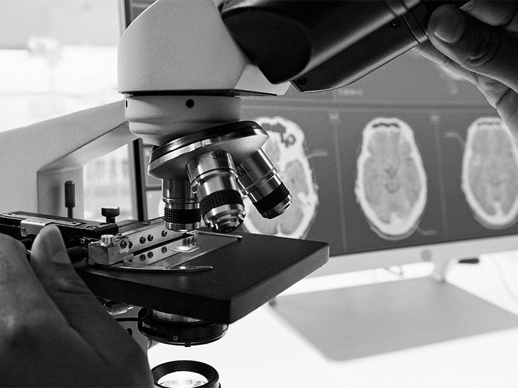 La bryostatine-1 pourrait stopper le déclin cognitif dans la maladie d'Alzheimer avancée, selon un essai