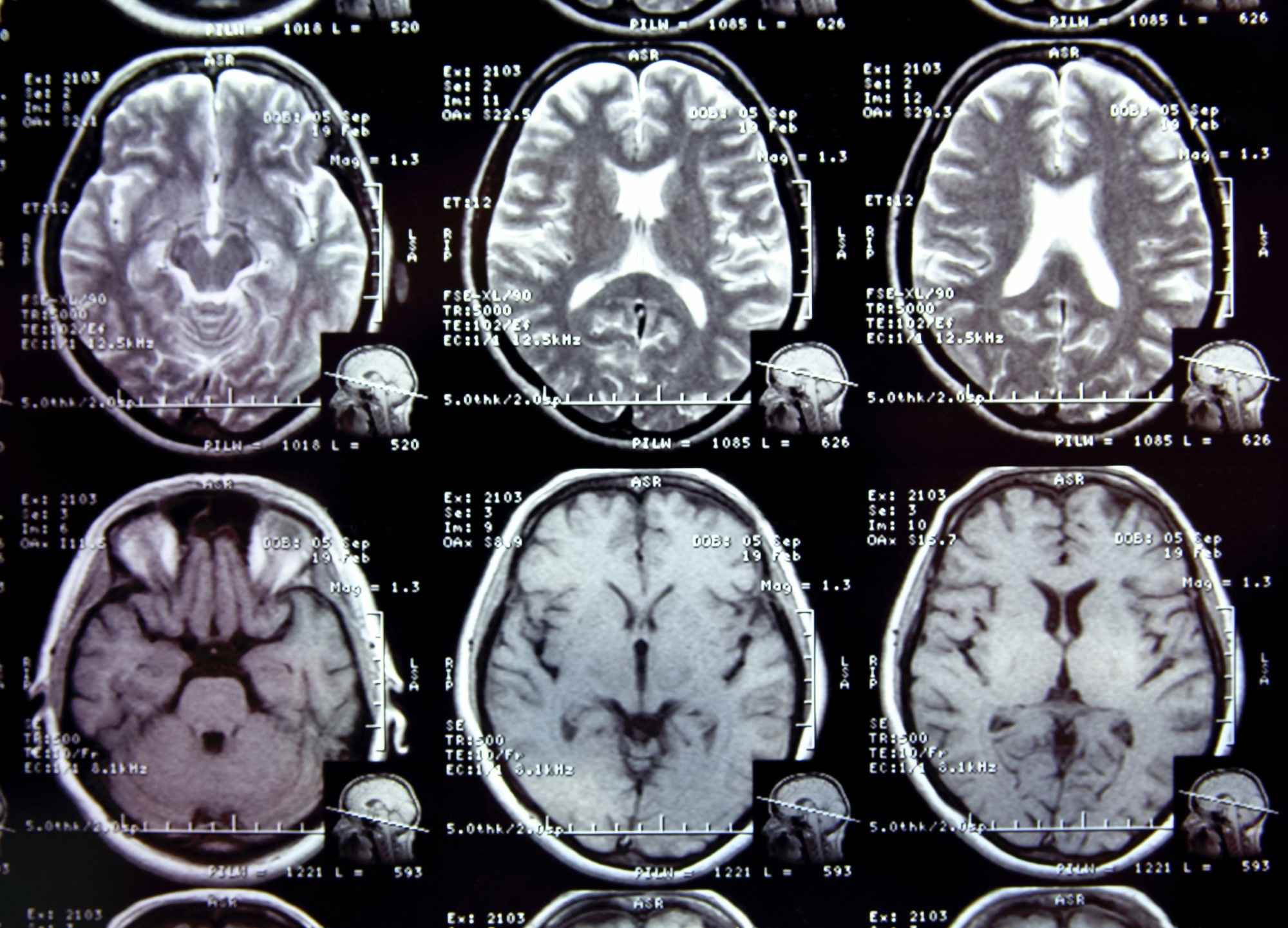 Study: COVID-19 and the impact on Alzheimer