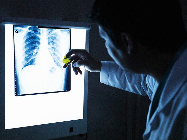 Les radiologues surpassent l’IA dans l’identification des maladies pulmonaires sur les radiographies pulmonaires
