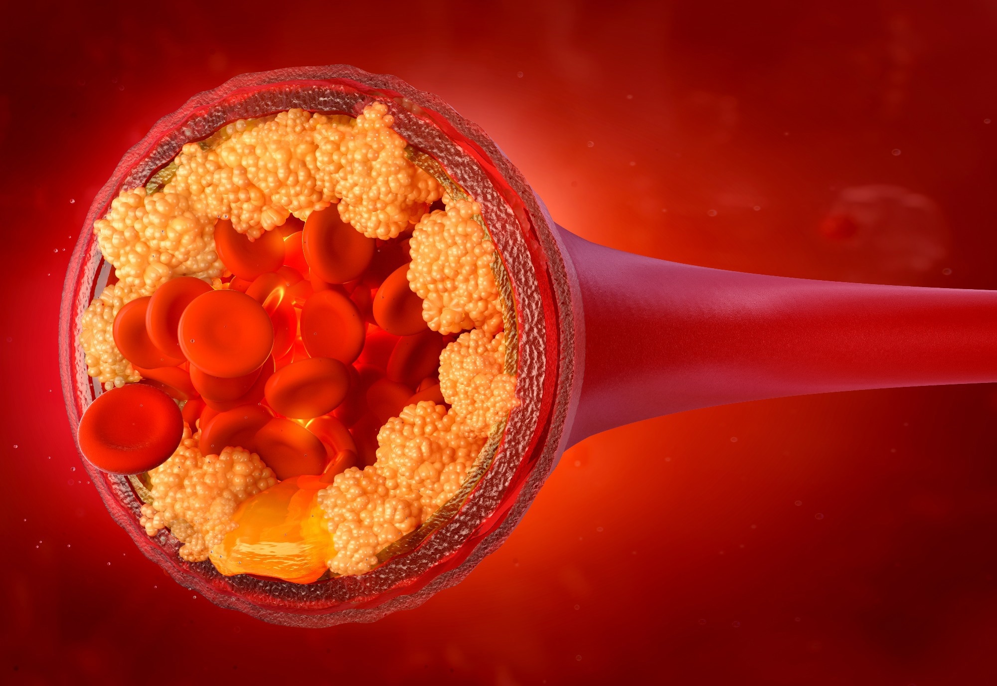 Study: Association of dietary fatty acids with the risk of atherosclerotic cardiovascular disease in a prospective cohort of United States veterans. Image Credit: Corona Borealis Studio / Shutterstock