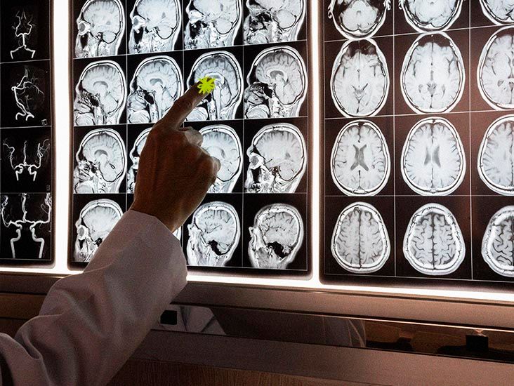 La réduction du cholestérol cérébral pourrait-elle réduire les dommages de type Alzheimer ?