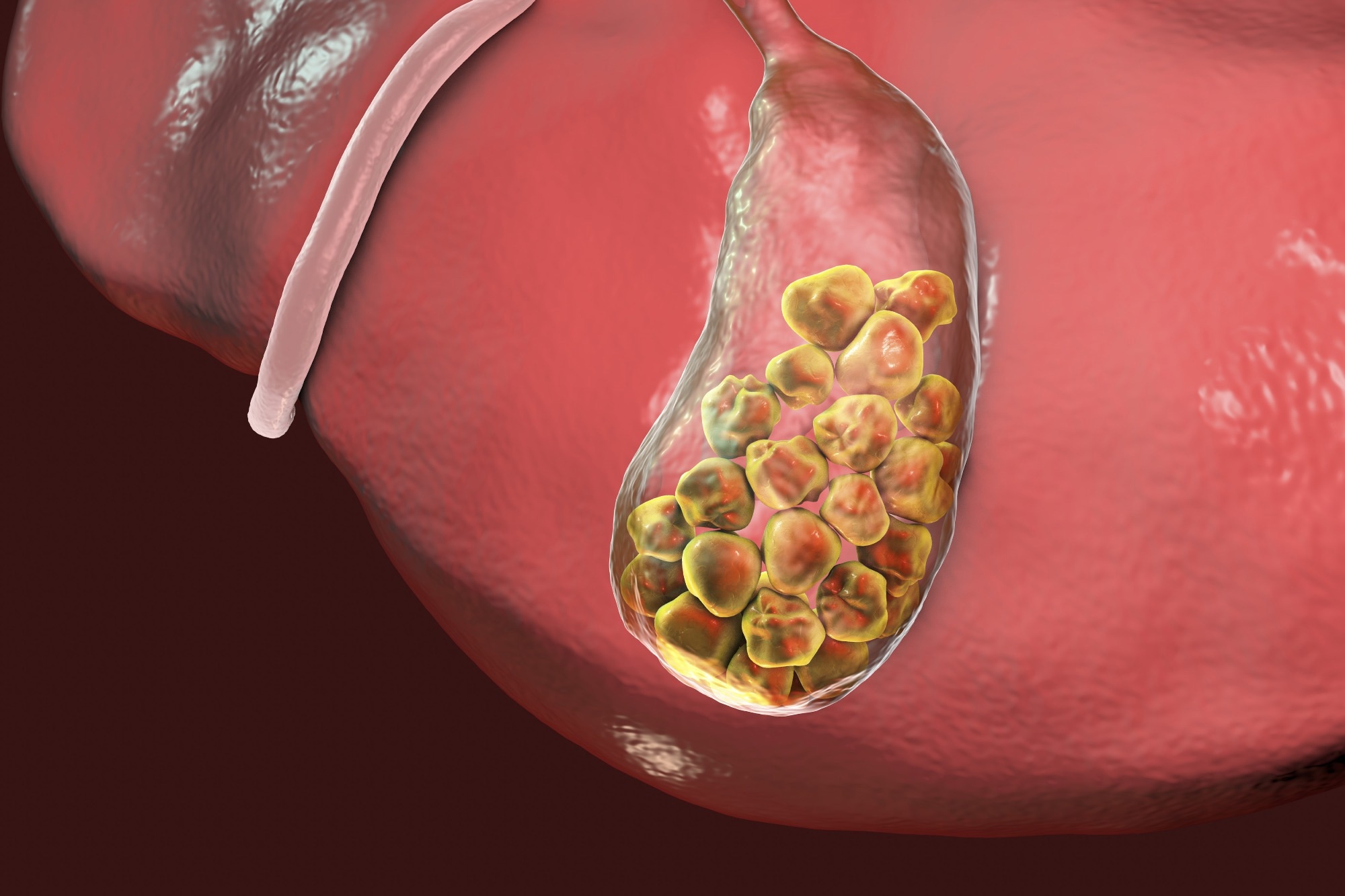 Image of gall stones
