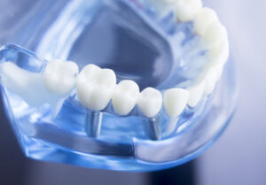Comment prendre soin de ses dents au quotidien ?