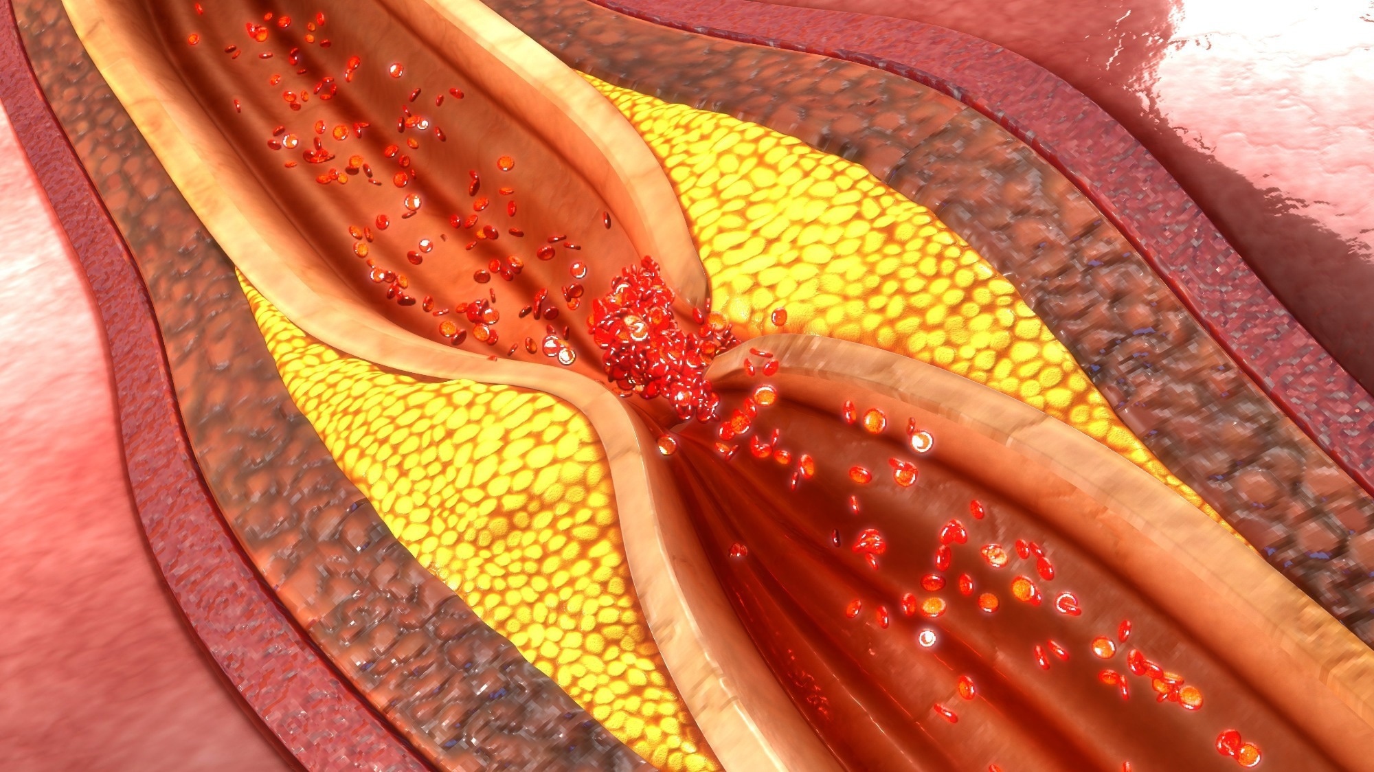 Letter: Whole-genome sequencing uncovers two loci for coronary artery calcification and identifies ARSE as a regulator of vascular calcification. Image Credit: sciencepics / Shutterstock