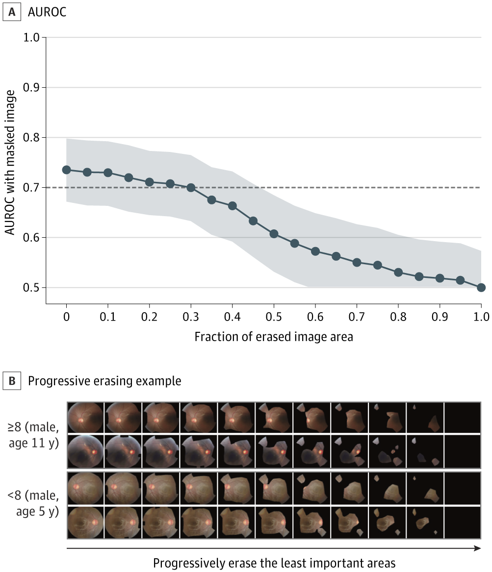 Validation quantitative de la carte thermique avec la technique d'effacement progressif pour le dépistage de la gravité des symptômes basé sur ADOS-2. A, Aire sous la courbe caractéristique de fonctionnement du récepteur (AUROC) avec IC ombré à 95 % obtenu à partir d'images masquées. B, Effacement progressif pour les troubles du spectre autistique (TSA) sévères et les TSA légers à modérés. ADOS-2 indique le calendrier d'observation du diagnostic de l'autisme – deuxième édition.