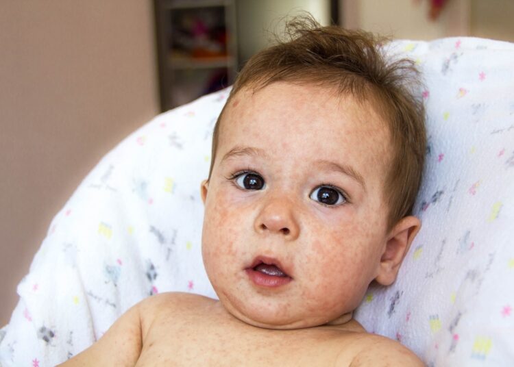 Study: Feast for Thought: A Comprehensive Review of Food Allergy 2021-2023. Image Credit: Yavdat / Shutterstock