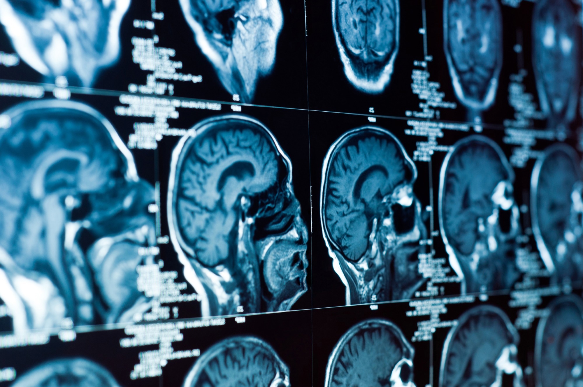 Study: Interplay of early negative life events, development of orbitofrontal cortical thickness and depression in young adulthood. Image Credit: SvedOliver/Shutterstock.com