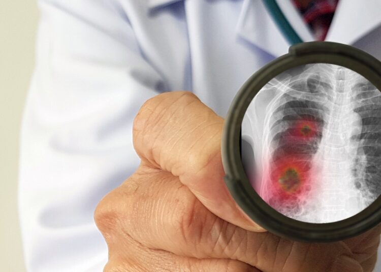 Study: Pneumococcal serotypes and risk factors in adult community-acquired pneumonia 2018–20; a multicentre UK cohort study. Image Credit: joel bubble ben/Shutterstock.com
