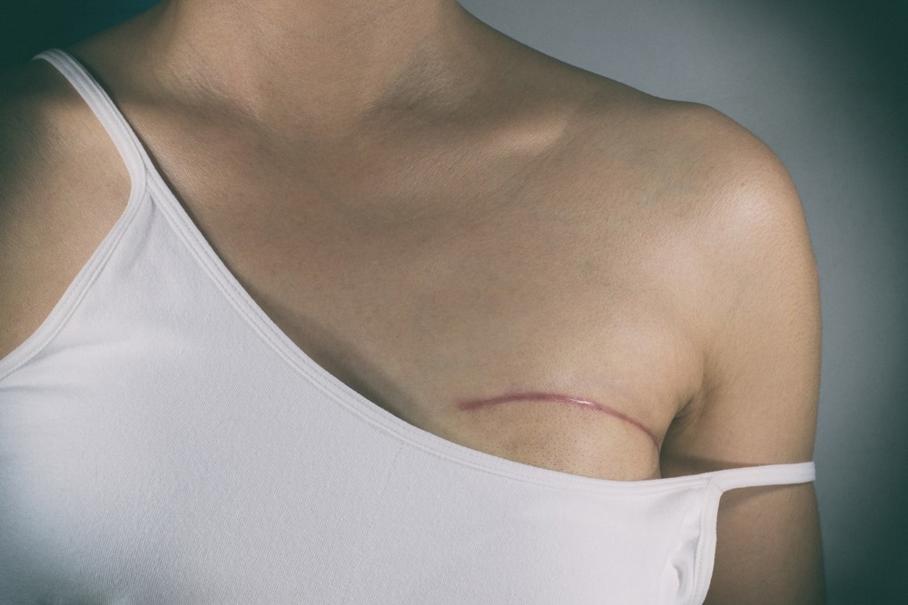 Study: Safety and Feasibility of Single-Port Robotic-Assisted Nipple-Sparing Mastectomy. Image Credit: Pradit.Ph/Shutterstock.com