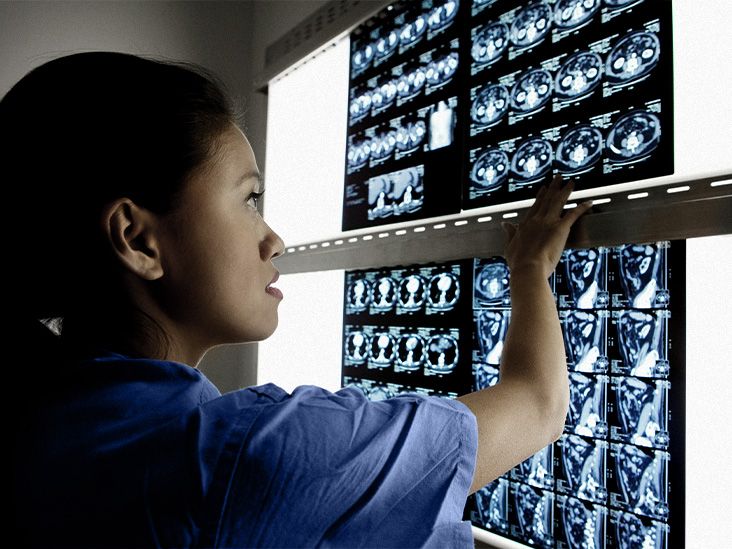 La maladie d'Alzheimer peut avoir été transmise par une procédure médicale qui n'est plus utilisée : ce qu'il faut savoir