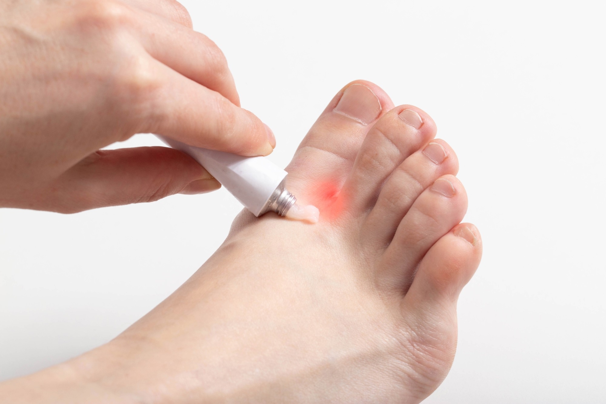 Study: ­­­­­­Topical Antifungal Prescribing for Medicare Part D Beneficiaries — United States, 2021. ​​​​​​​Image Credit: HenadziPechan / Shutterstock