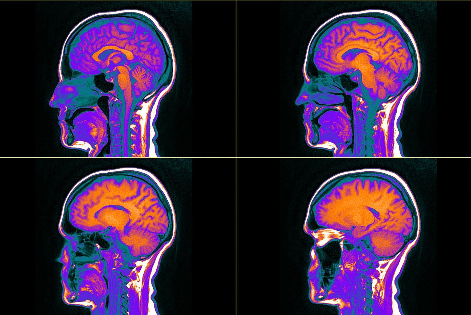 Les croyances sur la nicotine provoquent des réactions dose-réponse dans le cerveau humain