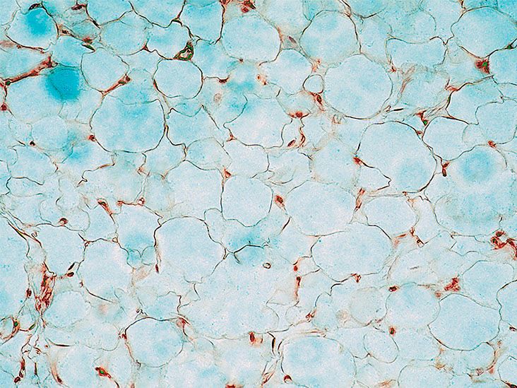 Human fat cells viewed under a microscope