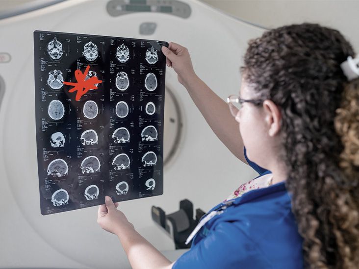 Une approche par ultrasons pourrait administrer un médicament contre la maladie d'Alzheimer directement au cerveau