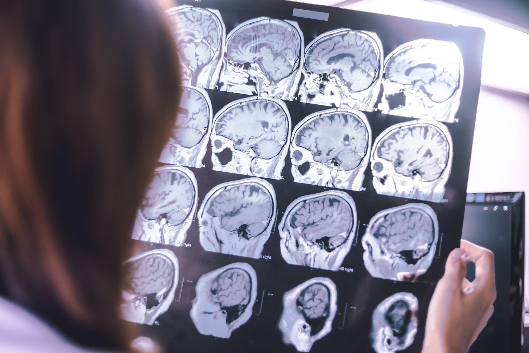 Study: Plasma proteomic profiles predict future dementia in healthy adults. Image Credit: Atthapon Raksthaput/Shutterstock.com