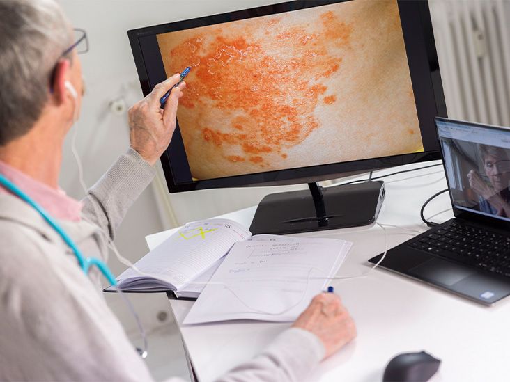 Comment le psoriasis se propage-t-il dans tout le corps ?  Une étude aide à expliquer