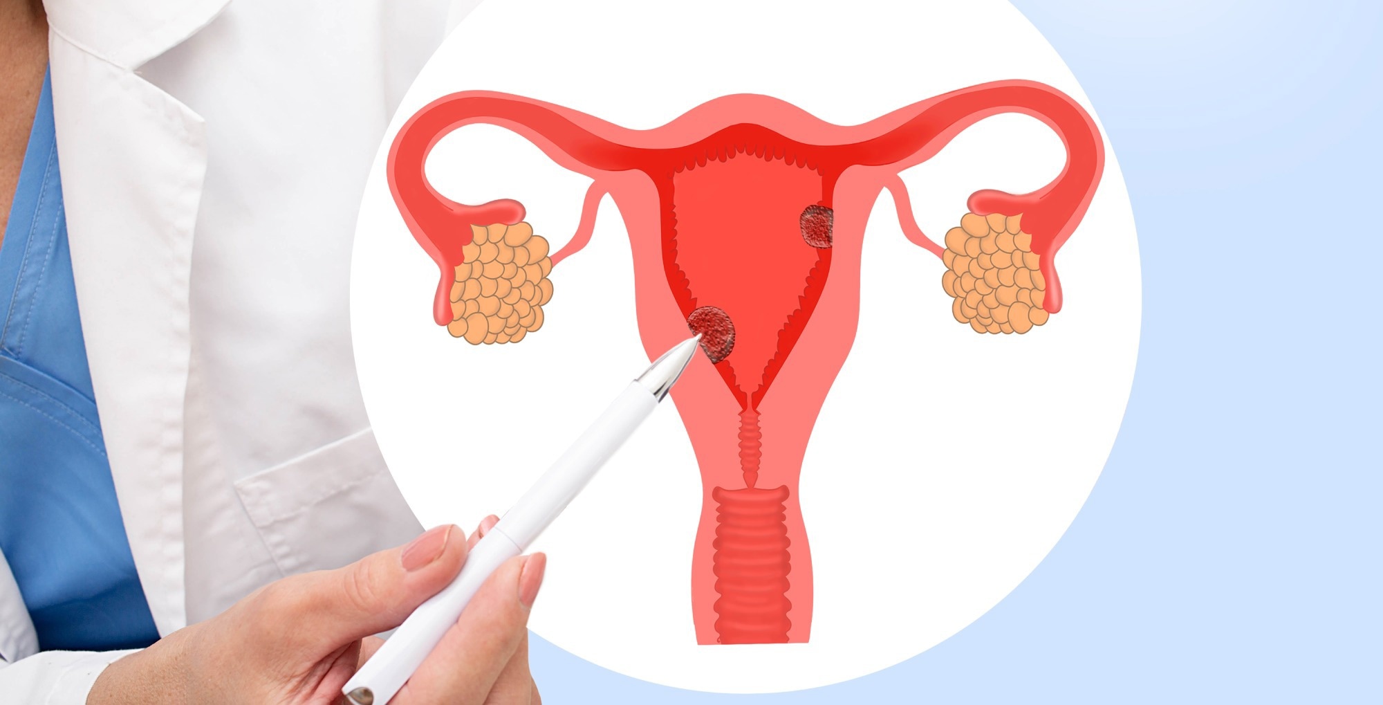 Génétique de la production d'œstrogènes liée au risque de cancer de l'endomètre chez les femmes ménopausées