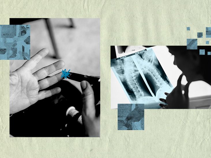 A collage and illustration of a person measuring their blood sugar via finger prick test and an X-ray of the spine, side by side