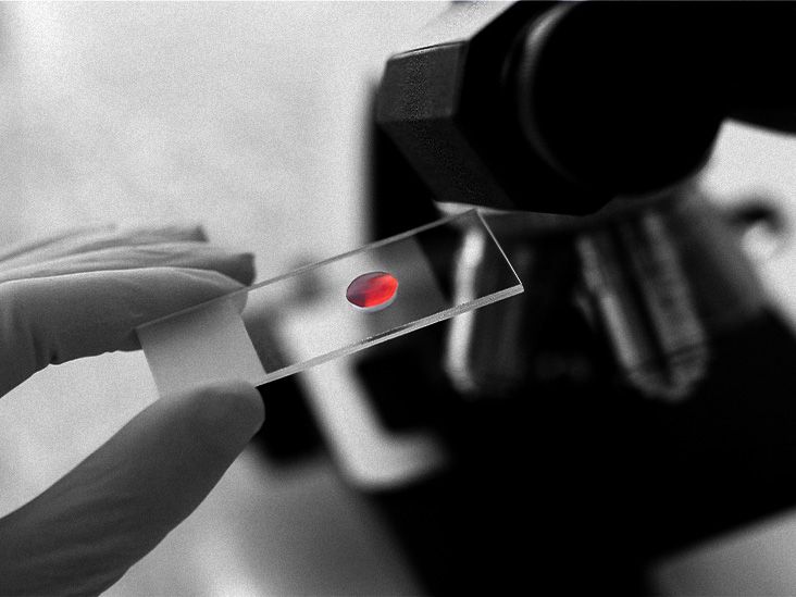 Les infections virales au cours de la vie pourraient-elles influencer le risque d'Alzheimer ?