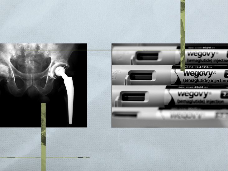 An illustration of a hip bone X-ray and 4 injections of semaglutide belonging to the Wegovy brand
