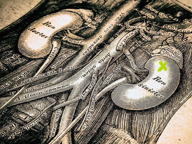 Les médicaments contre le diabète de type 2 pourraient contribuer à réduire de 30 % le risque de calculs rénaux