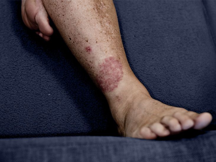 Les mutations somatiques dans les cellules de la peau ne provoquent pas de psoriasis, selon une étude