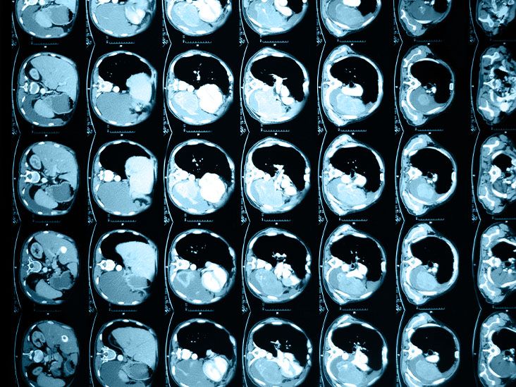 L'obésité peut affecter les processus métaboliques et la fonction hépatique, selon une étude