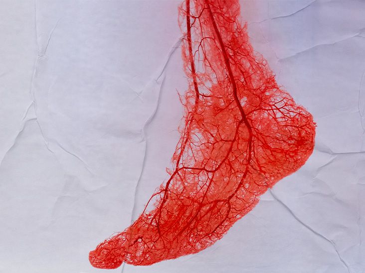 Prendre des anticoagulants après un accident vasculaire cérébral n’améliore pas les résultats, selon une étude