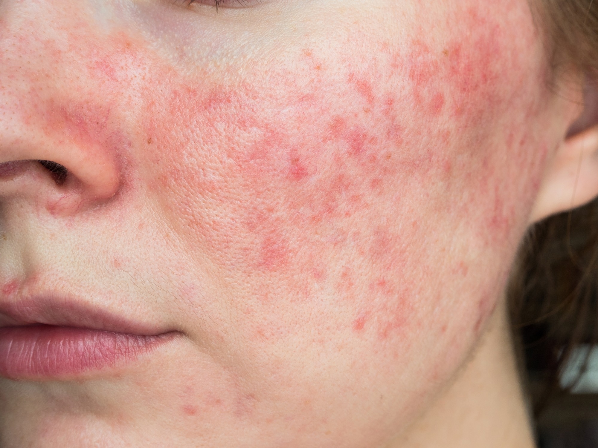 Study: Recent Advances in the Management of Rosacea through Natural Compounds. Image Credit: Julia Shauerman/Shutterstock.com