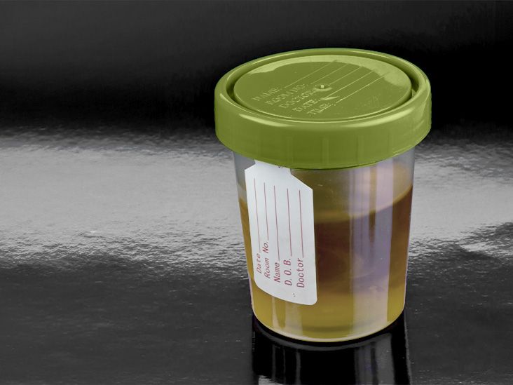 Un nouveau test d'urine pourrait permettre de détecter précocement le cancer de l'ovaire