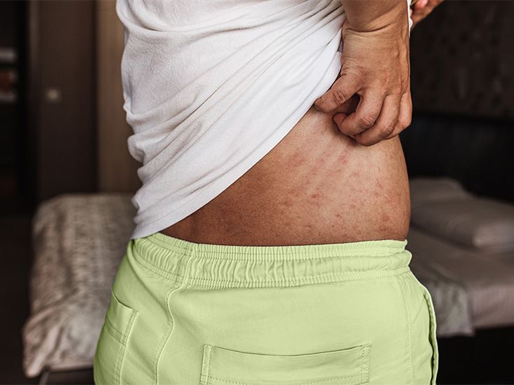 Comment la recherche sur l'eczéma sur les bactéries cutanées peut conduire à un traitement contre les démangeaisons
