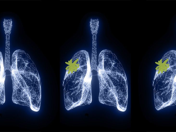 Des chercheurs développent un test de dépistage inhalable du cancer du poumon