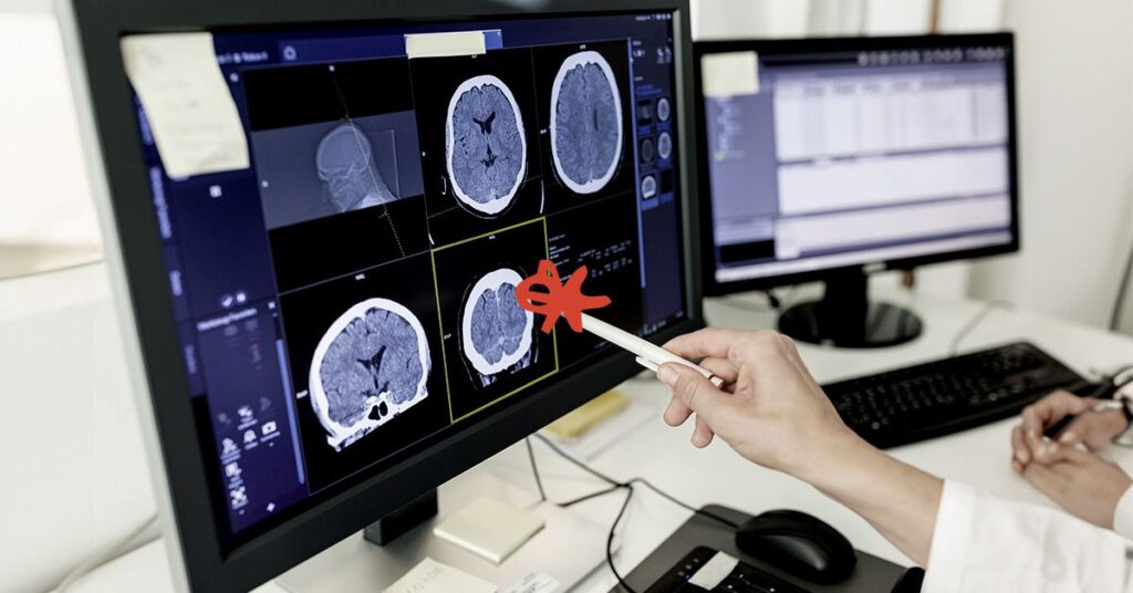 La maladie d'Alzheimer pourrait être causée par une accumulation de graisse dans les cellules cérébrales