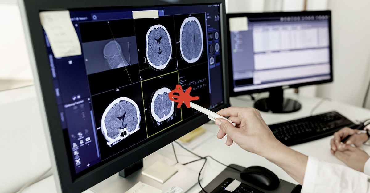 La maladie d'Alzheimer pourrait être causée par une accumulation de graisse dans les cellules cérébrales