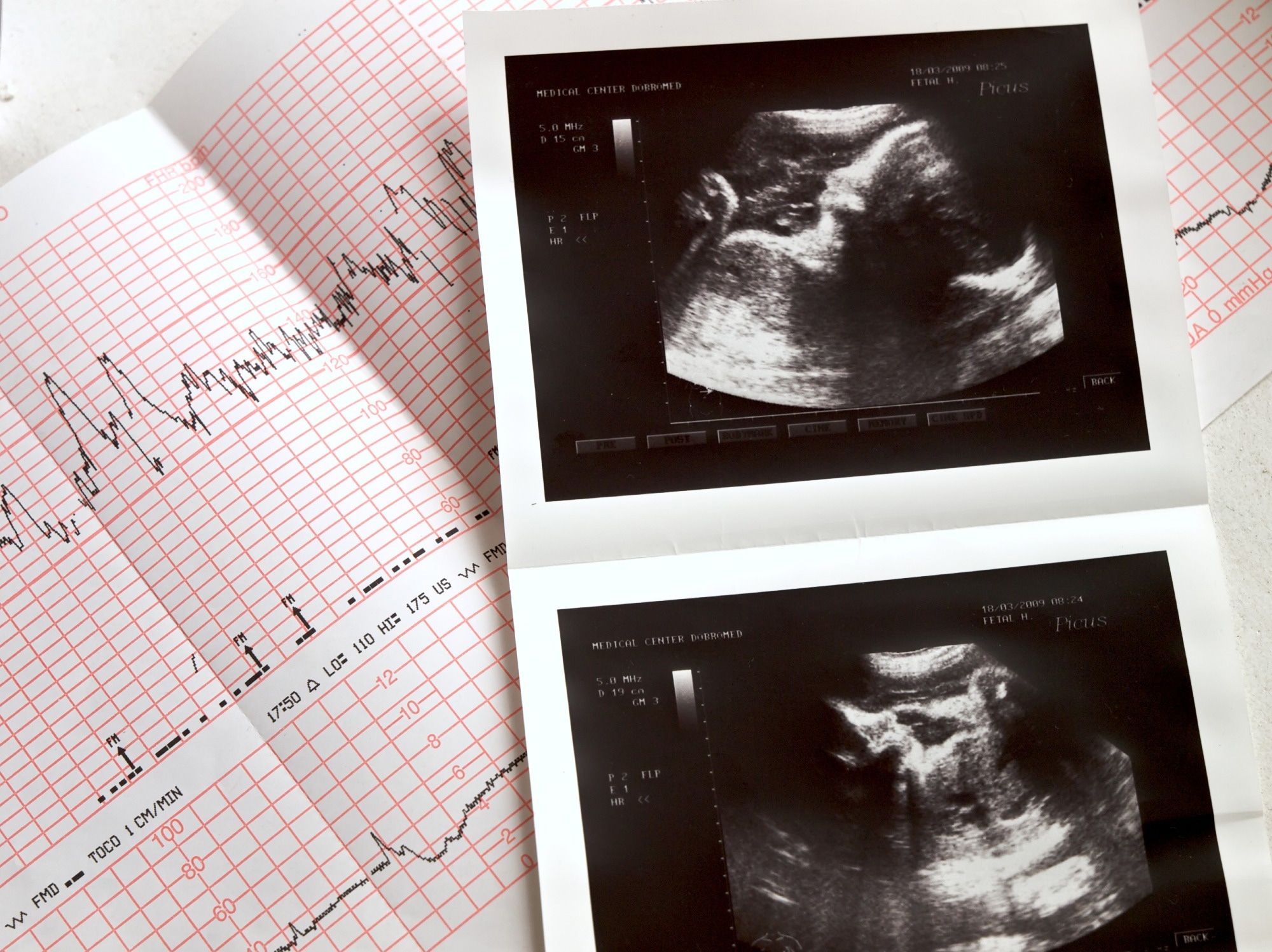 Les chercheurs découvrent des cellules cardiaques diverses et spatialement coordonnées impliquées dans le développement du cœur