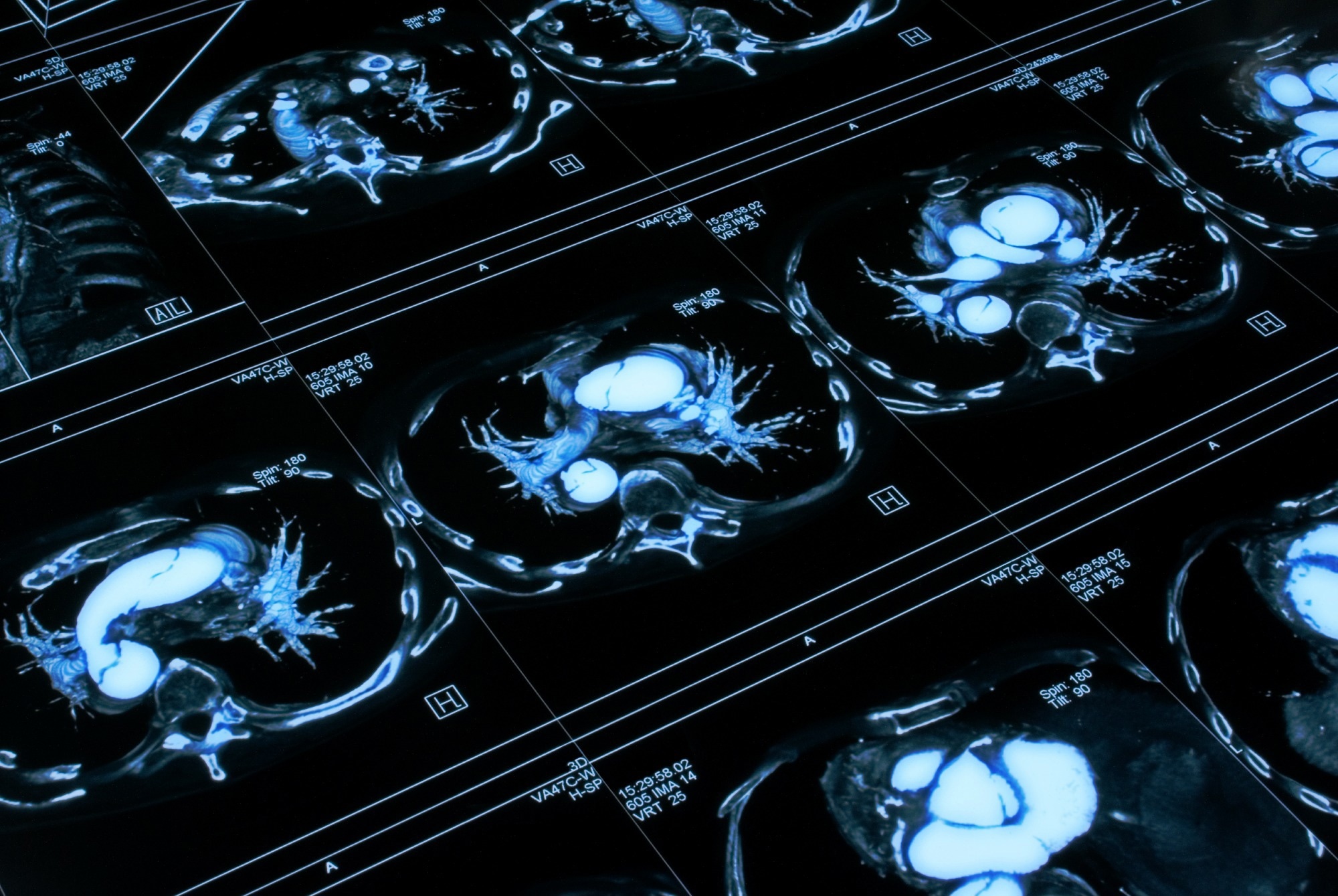 Study: Spatially organized cellular communities form the developing human heart. Image Credit: beerkoff / Shutterstock