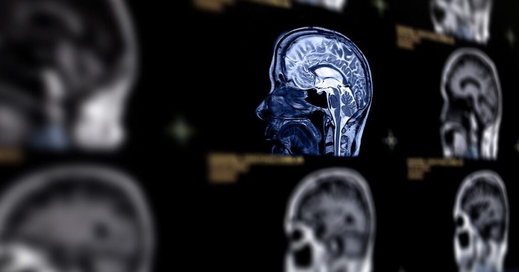 L'obésité et un régime riche en graisses peuvent accélérer le vieillissement cérébral et entraîner un déclin cognitif
