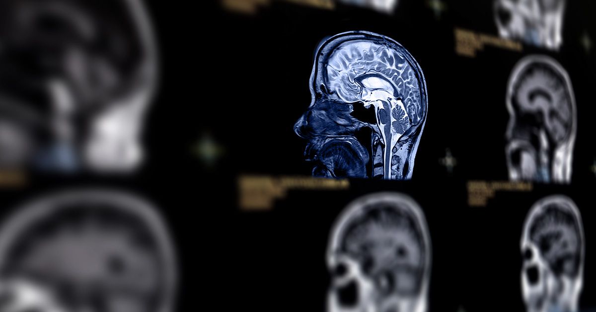 L'obésité et un régime riche en graisses peuvent accélérer le vieillissement cérébral et entraîner un déclin cognitif