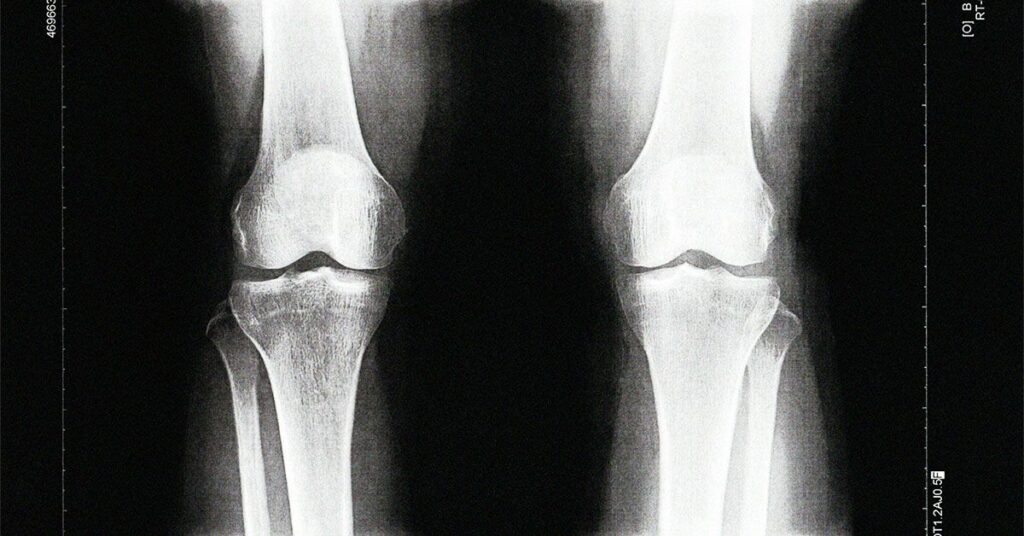 Un test sanguin pourrait permettre de détecter l'arthrose 8 ans plus tôt qu'une radiographie