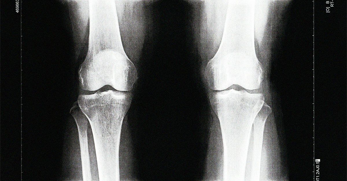 Un test sanguin pourrait permettre de détecter l'arthrose 8 ans plus tôt qu'une radiographie
