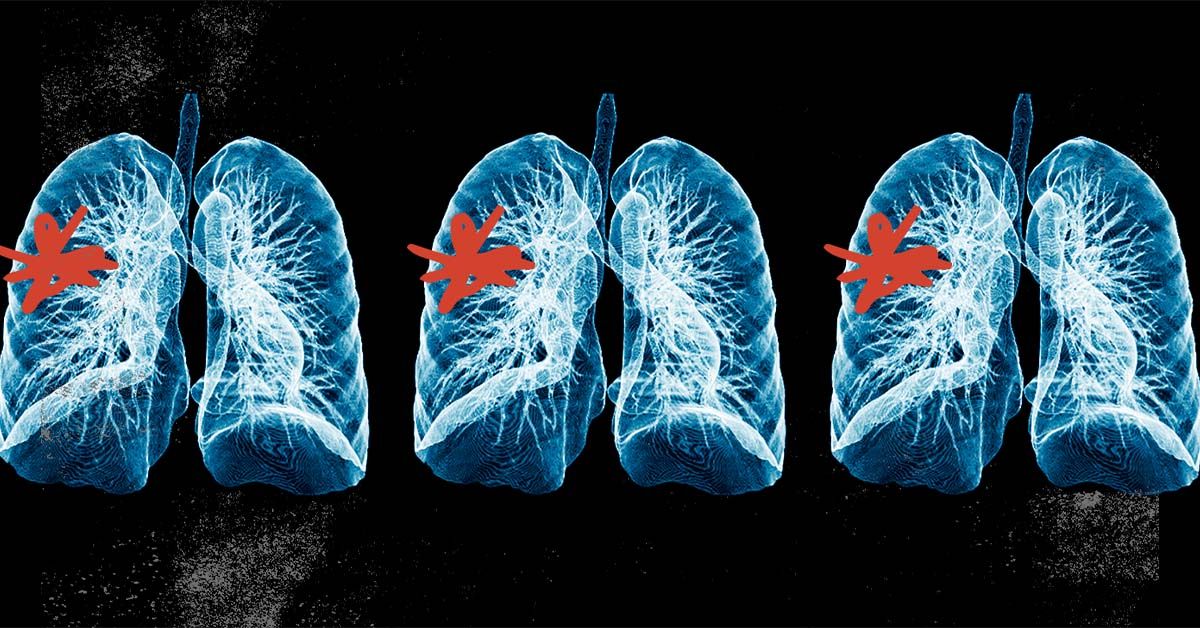 Comment le diagnostic et le traitement précoces de l’asthme et de la BPCO peuvent améliorer considérablement la qualité de vie