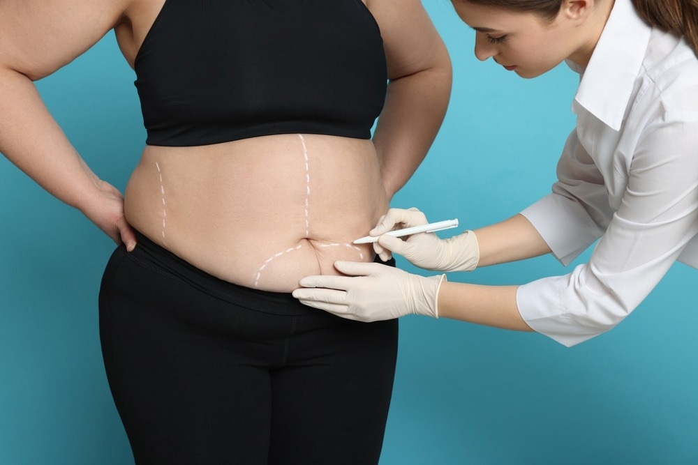 Study: Breast Cancer Risk After Bariatric Surgery and Influence of Insulin Levels A Nonrandomized Controlled Trial. Image Credit: New Africa/Shutterstock.com