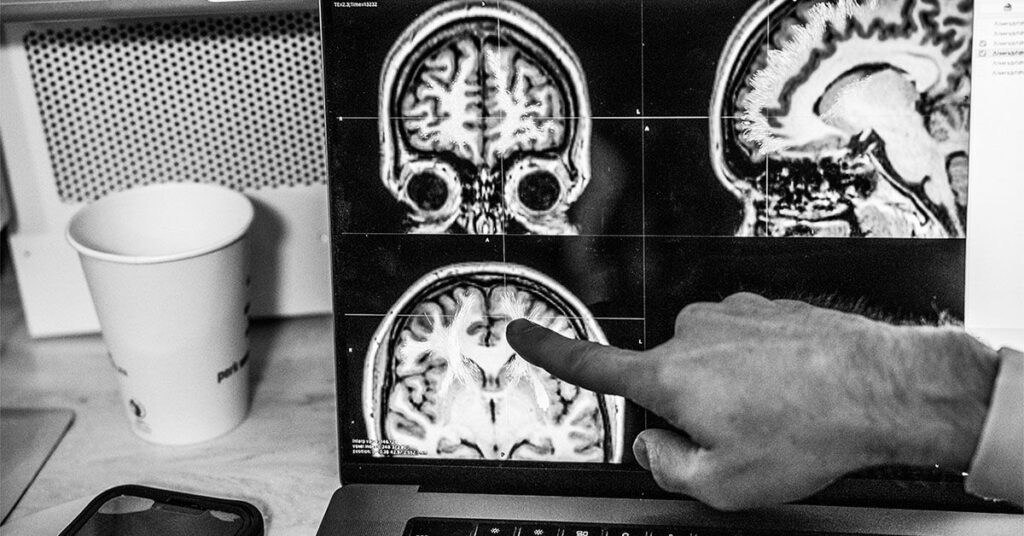 Le vieillissement de la substance blanche dans le cerveau peut affecter la guérison d’un AVC, selon une étude