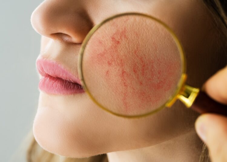 Study: Rosacea is strongly associated with melanoma in Caucasians. Image Credit: Andrey_Popov/Shutterstock.com