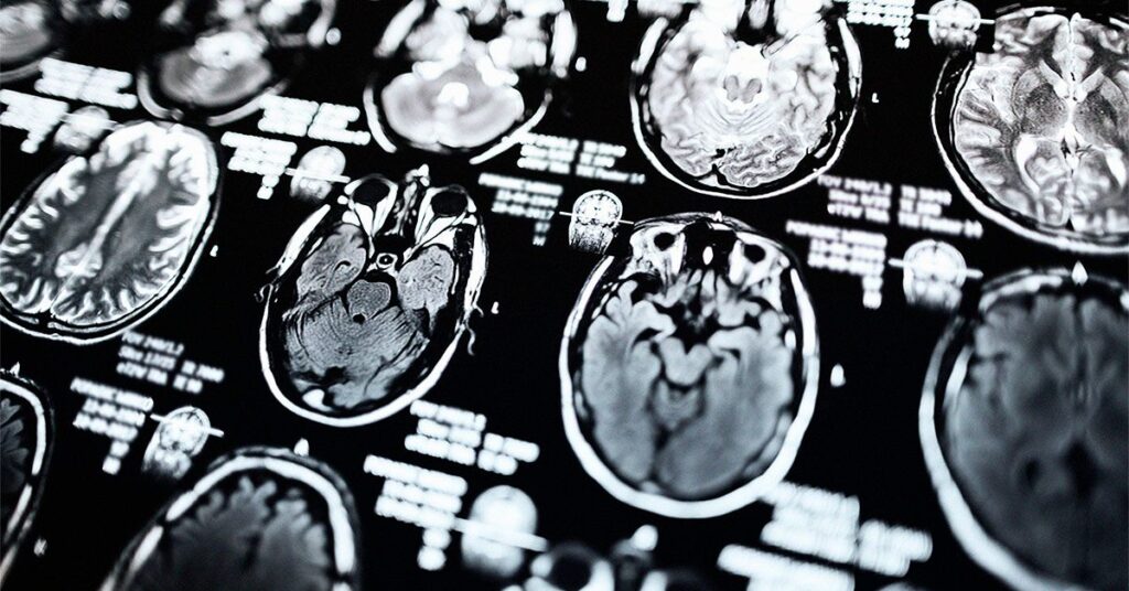 Comment les examens IRM peuvent aider au diagnostic et aux traitements de la maladie de Parkinson