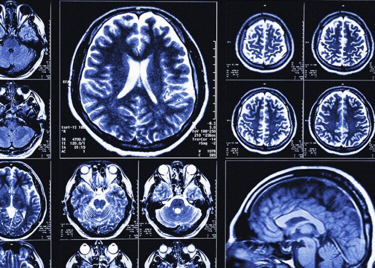Des scientifiques créent un outil d'IA qui permet de prédire la maladie d'Alzheimer avec une précision allant jusqu'à 82 %