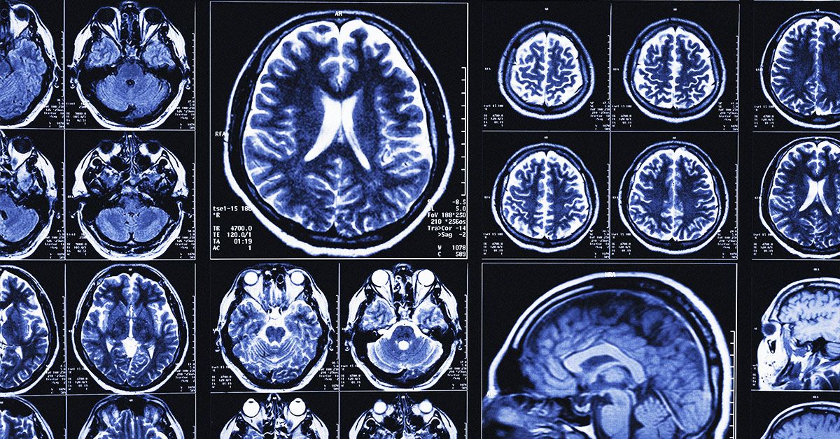 Des scientifiques créent un outil d'IA qui permet de prédire la maladie d'Alzheimer avec une précision allant jusqu'à 82 %
