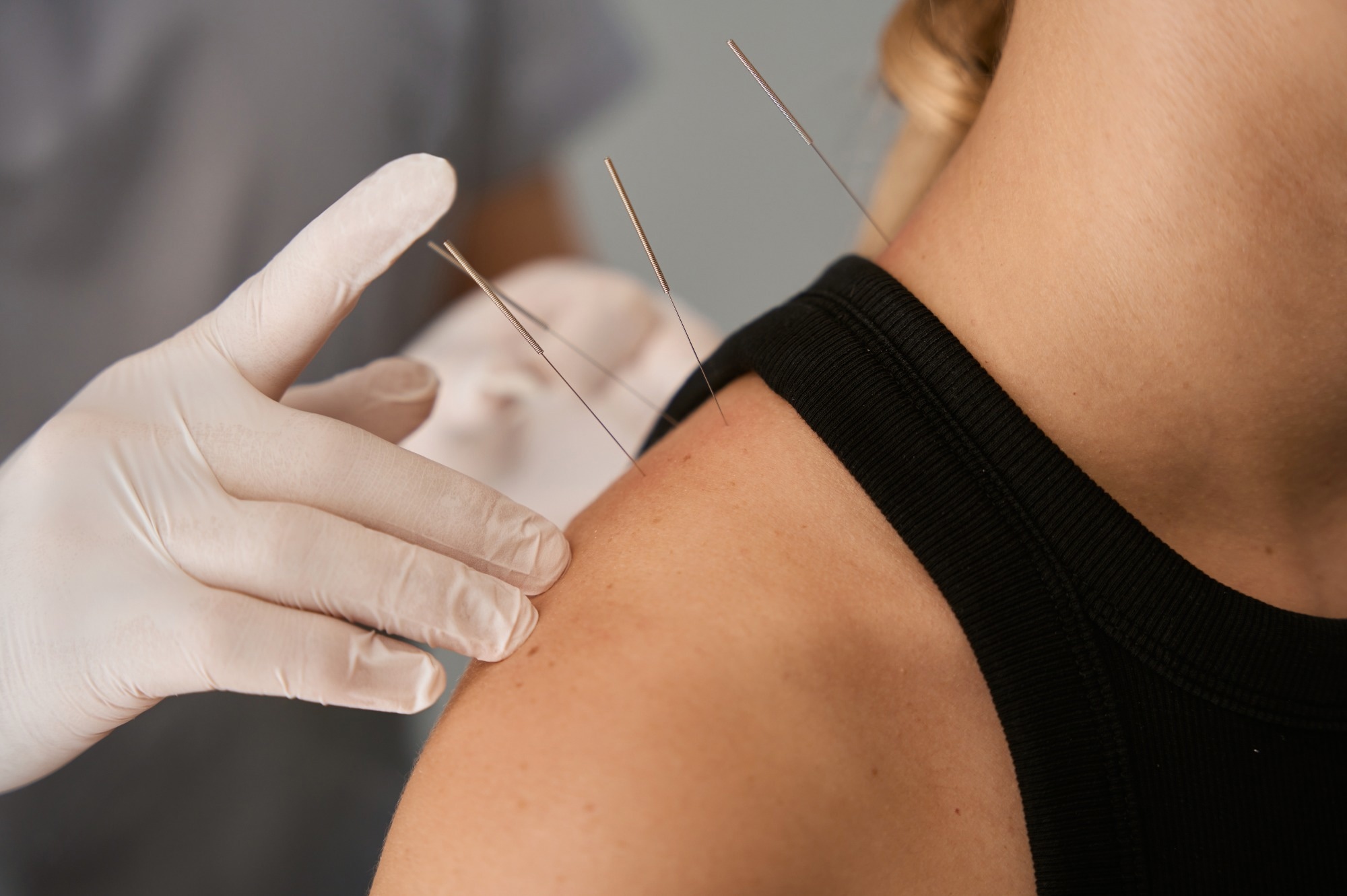 Study: Acupuncture and Sleep Quality Among Patients With Parkinson Disease. Image Credit: YAKOBCHUK VIACHESLAV/Shutterstock.com