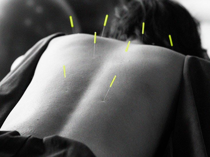 L'acupuncture peut aider à améliorer la qualité du sommeil dans la maladie de Parkinson